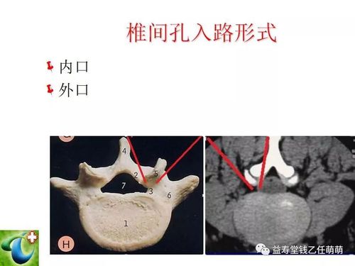 侧隐窝,椎间孔注射等临床实用技术