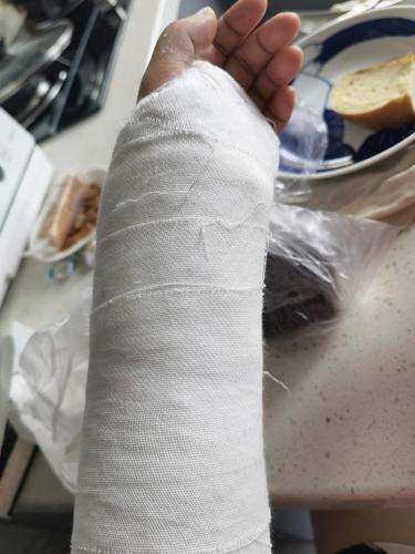 手腕三角骨折了
