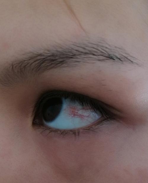 这几天照镜子看见眼睛有红血丝眼睛没有其他不适想知道这是怎