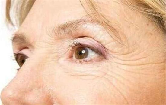 脸上皱纹怎么办优质