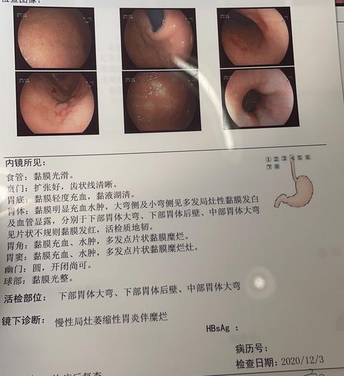 爸爸的胃镜病理报告,求求各位帮忙看看!