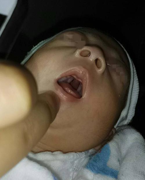腭裂宝宝可能的并发症与预防