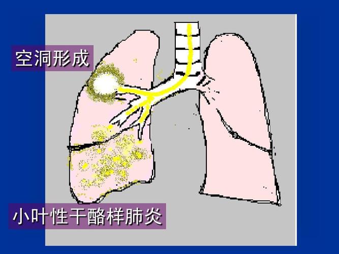 空洞形成 小叶性干酪样肺炎