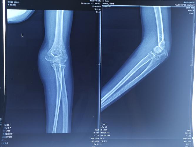 术后石膏固定35天,现患者左侧肘关节活动受限,关节活动度伸-屈:45-135