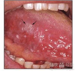 口里扁平苔藓是什么病