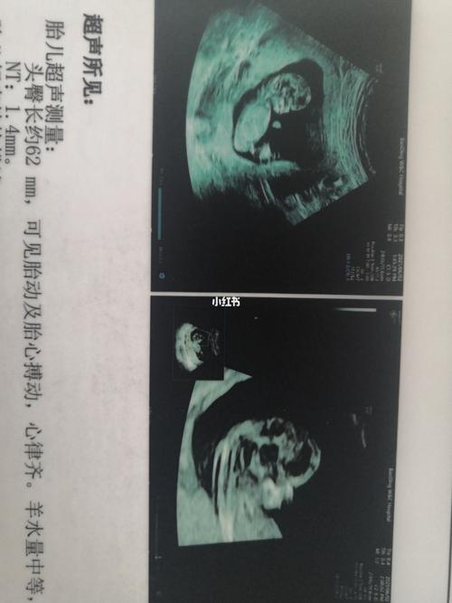 一切正常,美柚上显示孕11周776,超声结果显示孕周12周774,医生说