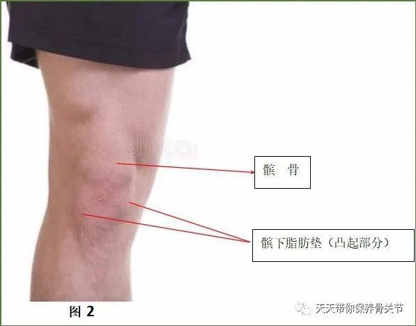 髌下脂肪垫损伤是怎么回事髌下脂肪垫损伤应该如何治疗