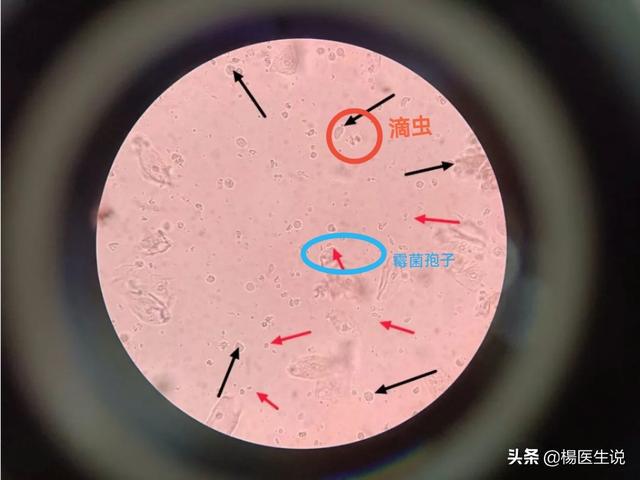 真实病例:滴虫合并霉菌性阴道炎,实属少见