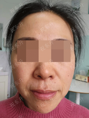 51岁做拉皮手术后15天,朋友们有点"不敢认"