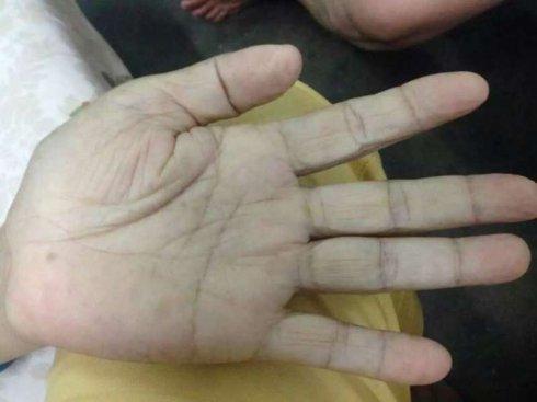 这是文昌68岁卧床3月胃癌晚期8天前未调理手掌图像图1,于氏师生调理8