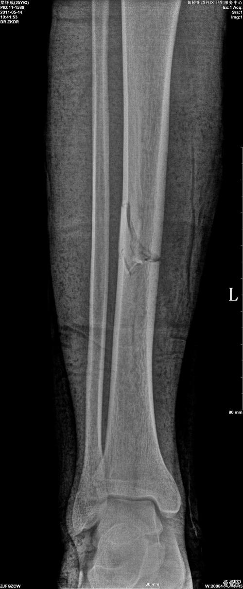 胫骨中段骨折保守治疗