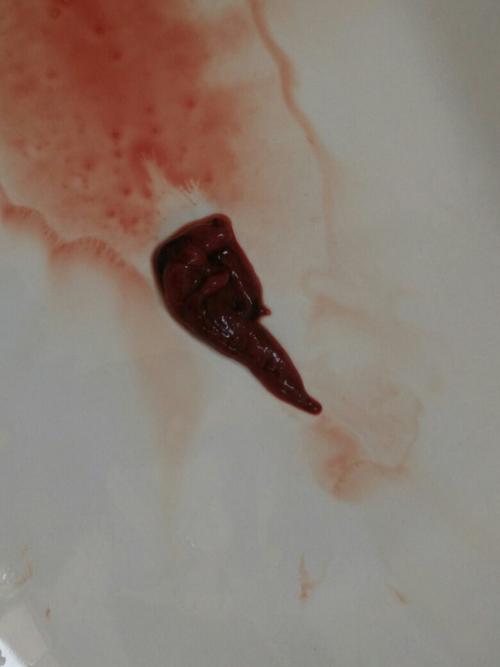 我怀孕了1个月流血请问这个是流出来的胎儿吗