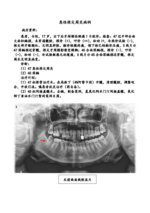 牙体牙髓病学3治疗方案急性根尖周炎病例doc文档doc1页