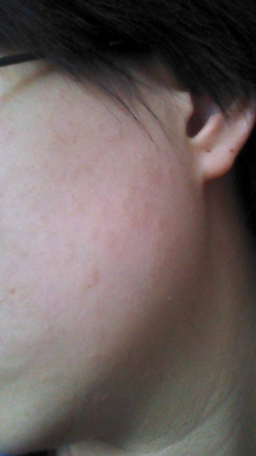 脸上皮肤有圆型状 微突起,边缘起身皮,中间光滑,并且瘙痒,请问是什么