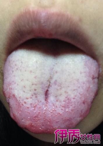 【图】盘点舌头中间有一条裂纹是什么病 教你重视身体的健康