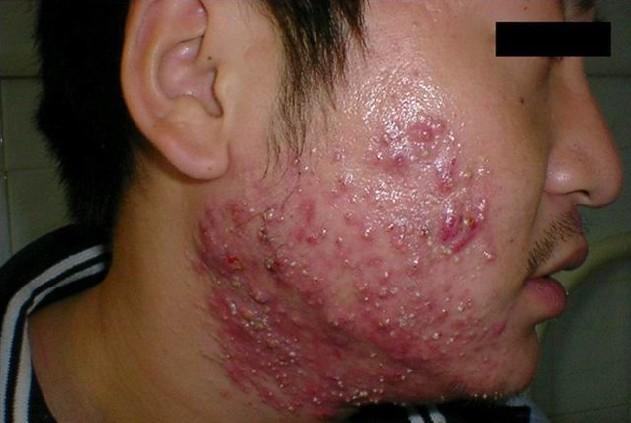 如何准确分辨痤疮