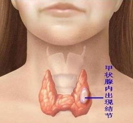 9旬老太太突发呼吸困难,甲状腺mtd助她化险为夷!