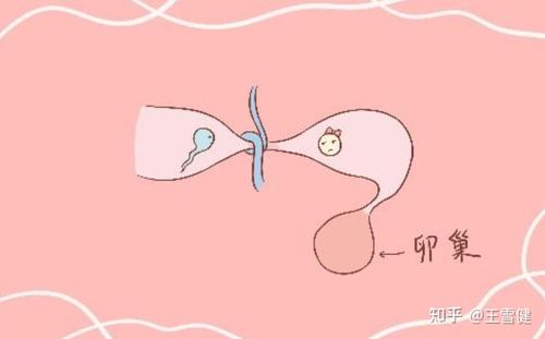 输卵管结扎已经有上百年历史,其避孕原理是将输卵管通道封闭,使卵子