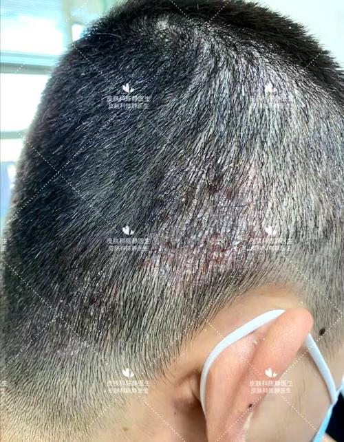 容易误诊的头皮疾病头皮银屑病头皮脂溢性皮炎