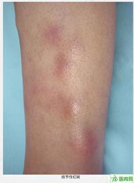 [转载]引起结节性红斑的发病原因有哪些