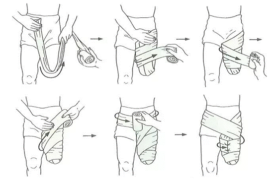 【四川省八一康复中心】战疫情:弹性绷带的使用——假肢康复训练及