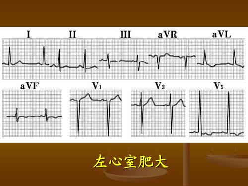 异常心电图的识别