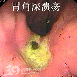胃角深溃疡