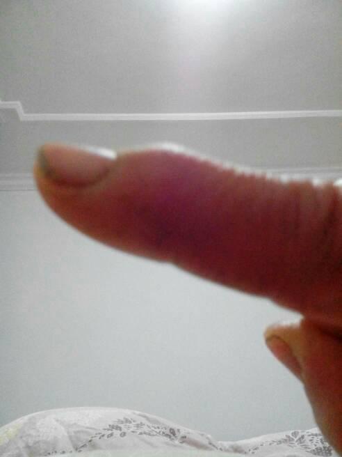 本人母亲手指关节处凸起包状,看上去白色,摸上去硬,按