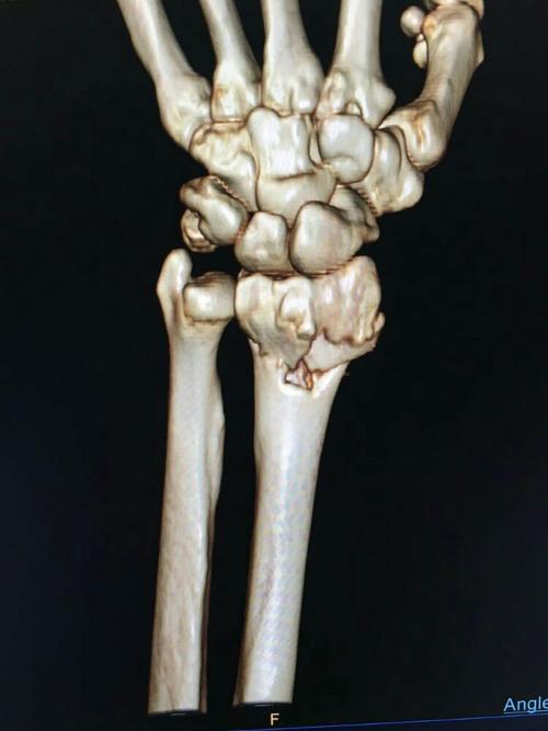 腕关节(桡骨远端骨折)