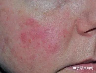 急性皮肤型红斑狼疮