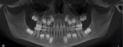 出生时:20颗乳牙的牙冠几乎全部形成并钙化,16颗恒牙牙胚形成恒牙