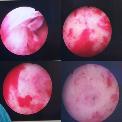 宫腔镜下宫腔散在片状出血,宫颈息肉,一侧输卵管口清晰可见.