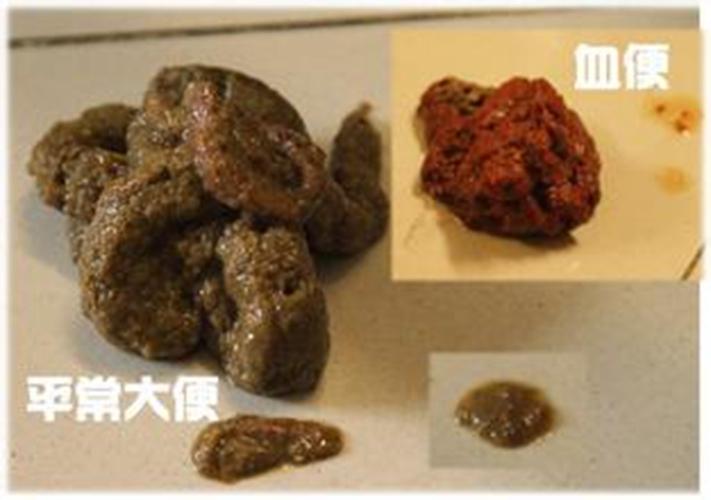 直肠癌的早期症状便血的图片