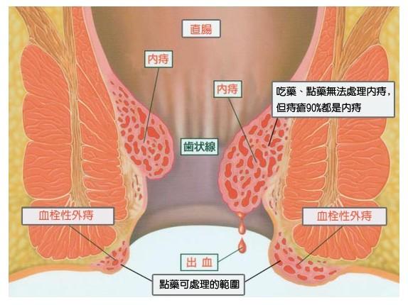 吉安治疗痔疮的专业医院!