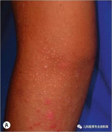 夏秋季,孩子最常见的皮肤病-沙土皮炎