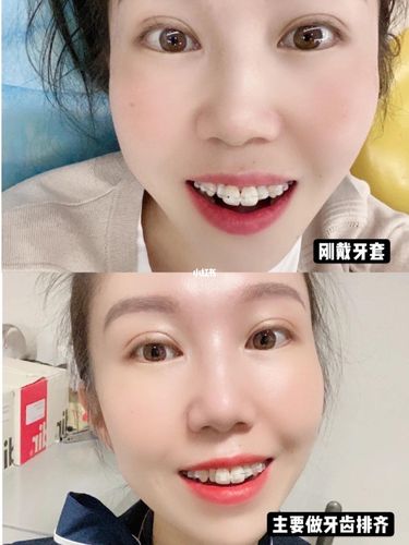 兔牙矫正92朝着整齐的牙齿出发~_牙齿矫正_牙套_骨钉_皮筋_美妆_医