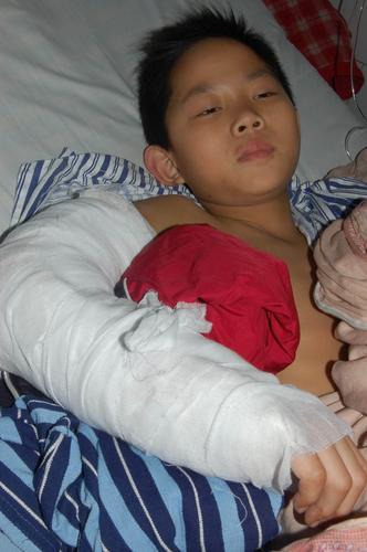 第十七则新闻(7楼跳下的小孩只是右手臂骨折严重!