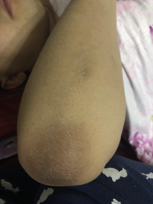 胳膊肘黑死皮