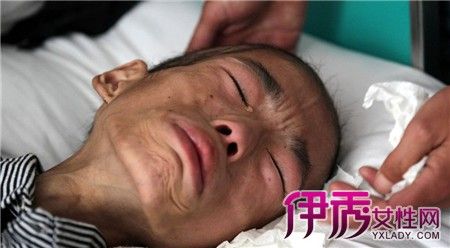 【图】淋巴癌晚期死前征兆有什么 3大症状告诉各位