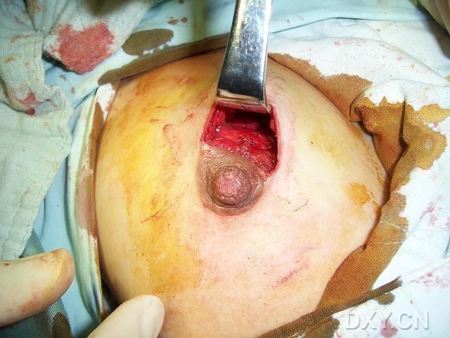 [转载]乳腺纤维腺瘤