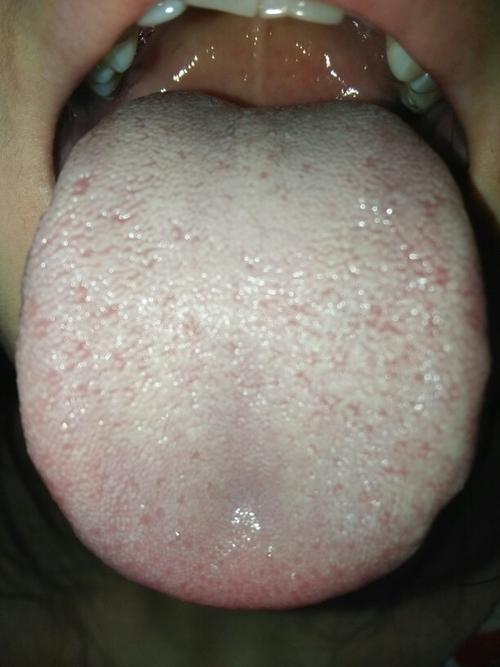 请问我这口腔是不是感染白念珠菌了?