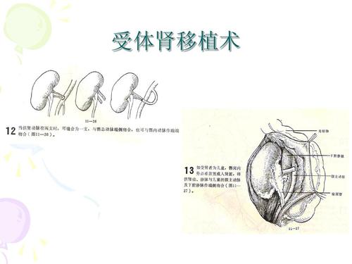 肾移植术的解剖ppt