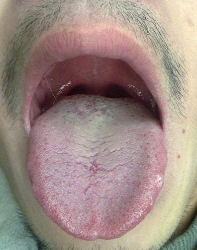 胃炎多长时间变胃癌舌头上一症状暗示癌变不要忽视