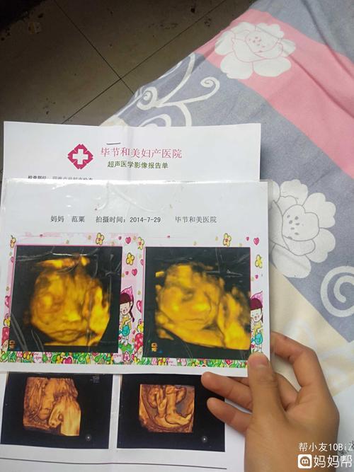 四维彩超3个小孩子的四维照片一个都不想