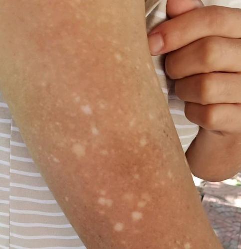 手臂皮肤病的特征