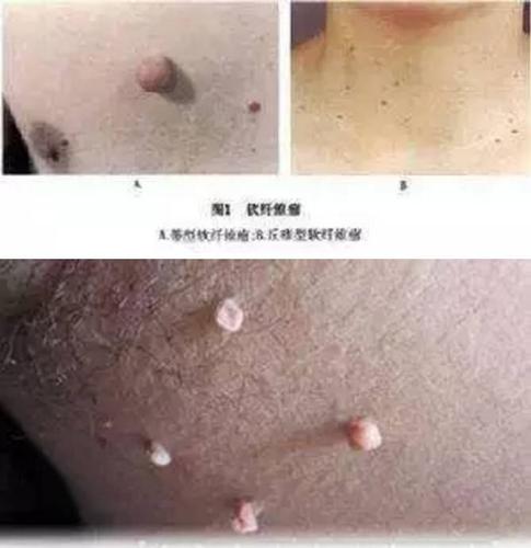 其它 正文  临床以多发性丝状或蒂状赘生物为主要表现,又称皮赘,软瘊.