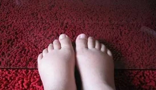 这种情况常见于中年和体胖者,女性更易发生