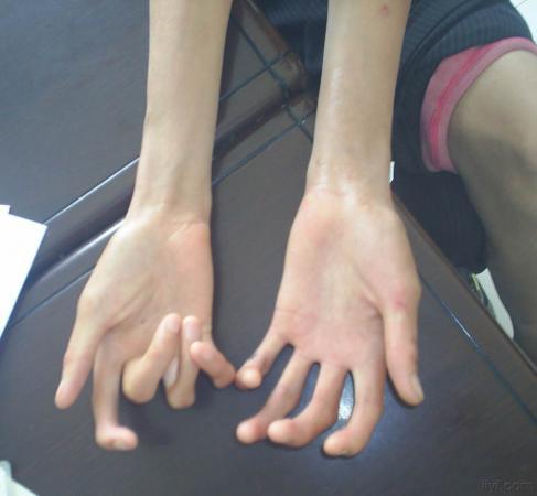 马凡氏综合症是什么?能活多久?