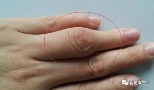 甚至容貌都渐渐变丑了,睡觉也开始打鼾,这很可能是得了肢端肥大症,而