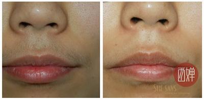 激光脱唇毛